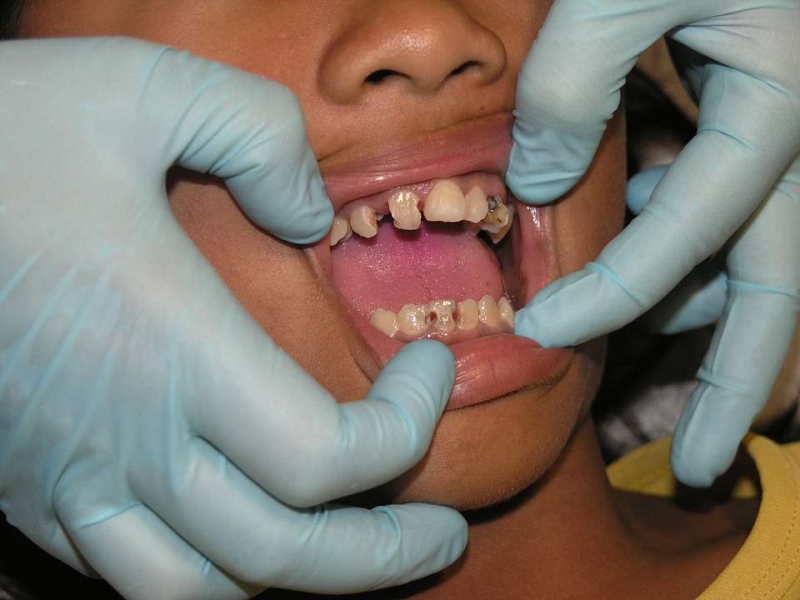 洗牙会伤害牙齿吗洗牙的注意事项